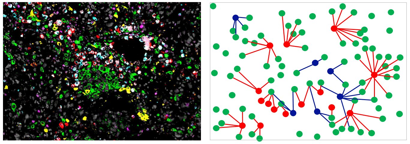 Komplexe Nachbarschaftsbeziehungen. Die mittels der sogenannten Multiplex-Immunfluoreszenzmikroskopie sichtbar gemachten Tumorzellen und unterschiedlichen Makrophagenpopulationen (links) wurden einer aufwändigen Lageanalyse unterzogen (rechtes Schema). Im Schema sind Tumorzellen grün, tumorhemmende Makrophagen blau und tumorfördernde Makrophagen rot dargestellt.
