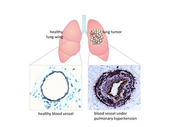 Hypertension associated with lung cancer: In the diagram, a tumour is shown in the right lung. Histological comparison of two blood vessels shows dramatic thickening of the wall of the vessel removed from the tumour region. Changes in blood vessels of this nature are responsible for the pulmonary hypertension observed in lung cancer patients. Hypertension associated with lung cancer: In the diagram, a tumour is shown in the right lung. Histological comparison of two blood vessels shows dramatic thickening of the wall of the vessel removed from the tumour region. Changes in blood vessels of this nature are responsible for the pulmonary hypertension observed in lung cancer patients.