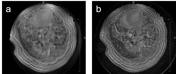 Fig. 5: Mouse lung MRI. Exemplary axial MR-images of a mouse lung with hyperplasia: (a) respiratory-gated UTE-3D sequence with a repetition time of 8.0 ms, echo time of 20 µs, slice thickness/interslice distance: 0.39/0.39 mm, field of view 2.50x2.70x5.00 cm3 and a matrix of 128/128/128 and (b) respiratory-gated ZTE-3D sequence with a repetition time of 4.0 ms, echo time of 0 µs, slice thickness/interslice distance: 0.16/0.16 mm, field of view 3.00x3.00x4.00cm3 and a matrix of 256/256/256. Fig. 5: Mouse lung MRI. Exemplary axial MR-images of a mouse lung with hyperplasia: (a) respiratory-gated UTE-3D sequence with a repetition time of 8.0 ms, echo time of 20 µs, slice thickness/interslice distance: 0.39/0.39 mm, field of view 2.50x2.70x5.00 cm3 and a matrix of 128/128/128 and (b) respiratory-gated ZTE-3D sequence with a repetition time of 4.0 ms, echo time of 0 µs, slice thickness/interslice distance: 0.16/0.16 mm, field of view 3.00x3.00x4.00cm3 and a matrix of 256/256/256.