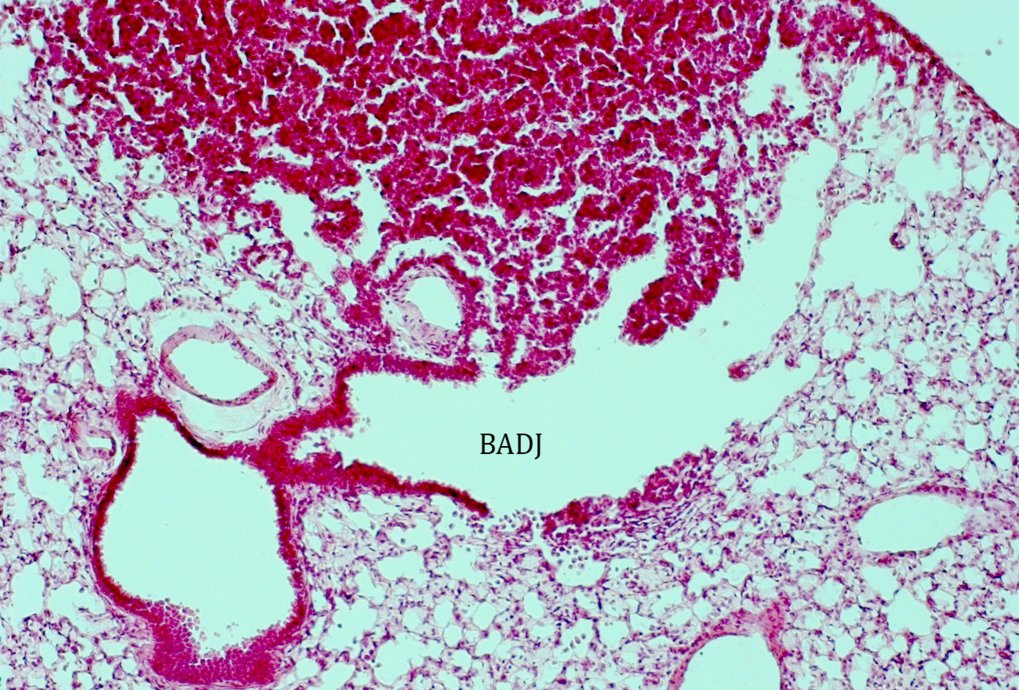 Neoplastic lesions frequently arise in the vicinity of bronchioalveolar duct junctions (BADJs).