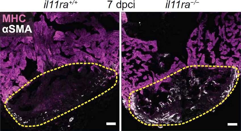 Il11ra protects zebrafish from scarring. In contrast to humans, zebrafish hardly activate scar-forming cells, the so-called myofibroblasts (left figure). This changes after the loss of the signal molecule interleukin-11 receptor (il11ra) (right figure). cardiac muscle cells = magenta; myofibroblasts = white Il11ra protects zebrafish from scarring. In contrast to humans, zebrafish hardly activate scar-forming cells, the so-called myofibroblasts (left figure). This changes after the loss of the signal molecule interleukin-11 receptor (il11ra) (right figure). cardiac muscle cells = magenta; myofibroblasts = white