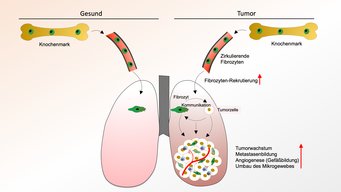 Schematische Darstellung der Interaktion zwischen Fibrozyten und Tumorzellen innerhalb des Mikroumgebung des Tumors. Bild: MPI für Herz- und Lungenforschung.  Schematische Darstellung der Interaktion zwischen Fibrozyten und Tumorzellen innerhalb des Mikroumgebung des Tumors. Bild: MPI für Herz- und Lungenforschung.