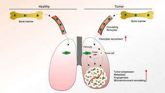 Schematic representation of interaction between fibrocytes and tumor cells within tumor microenvironment Schematic representation of interaction between fibrocytes and tumor cells within tumor microenvironment