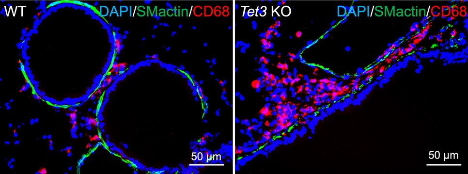 Microscopic view of immune cell infiltration of lungs in mice lacking the TET3 enzyme. Compared to the lungs of control animals (left), immune cells (macrophages, colored red) accumulate in the lungs of mice lacking TET3. Cell nuclei are stained blue, smooth muscle cells green.
