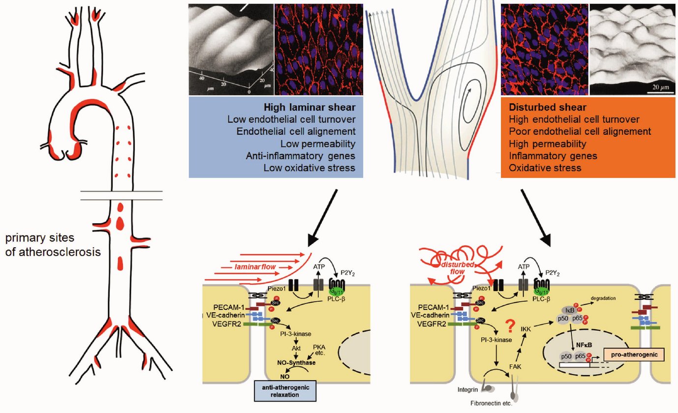 Atherosclerosis de­velops in areas of disturbed flow, which induces inflammatory signaling in endothelial cells. In contrast, laminar flow promotes athero­protective signaling.
