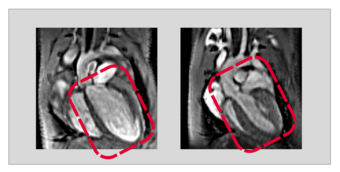 Niedrige USP5- Konzentration führt zur Herzmuskelschwäche. Die Abbildung zeigt Aufnahmen von Herzen mit Hilfe eines Magnetresonanz-Tomographen (MRT). Während das Herz des Kontrolltieres (rechts) in Bezug auf Größe und Stärke der Herzwand gesund ist, führt eine niedrige USP5-Konzentration zu einer Erweiterung des Herzens und einer Muskelschwäche (dilatative Kardiomyopathie, links). Niedrige USP5- Konzentration führt zur Herzmuskelschwäche. Die Abbildung zeigt Aufnahmen von Herzen mit Hilfe eines Magnetresonanz-Tomographen (MRT). Während das Herz des Kontrolltieres (rechts) in Bezug auf Größe und Stärke der Herzwand gesund ist, führt eine niedrige USP5-Konzentration zu einer Erweiterung des Herzens und einer Muskelschwäche (dilatative Kardiomyopathie, links).