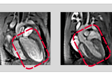 Recycling ist auch im menschlichen Körper wichtig: Ein gestörtes Recycling von Proteinen schädigt die Herzgesundheit