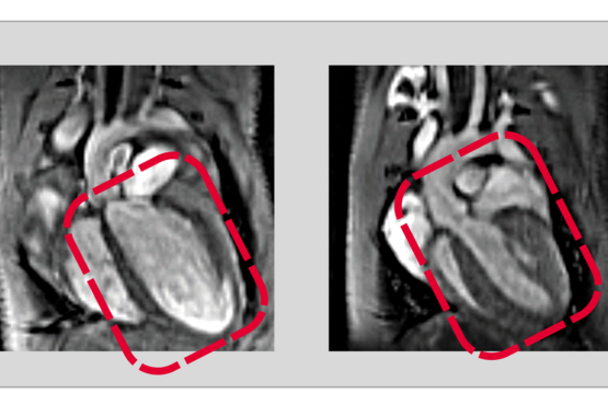 Recycling ist auch im menschlichen Körper wichtig: Ein gestörtes Recycling von Proteinen schädigt die Herzgesundheit