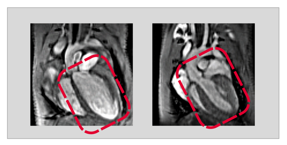 Low USP5 concentration leads to heart muscle weakness. The figure shows images of hearts using magnetic resonance imaging (MRI). While the heart of the control animal (right) is healthy in terms of size and thickness of the heart wall, a low USP5 concentration leads to dilatation of the heart and muscle weakness (dilated cardiomyopathy, left). Photo: MPI for Heart and Lung Research.