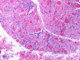 Bei der Duchenne Muskeldystrophie sterben zunehmend einzelne Muskelfasern ab. Im Laufe der Zeit entsteht so Muskelschwund. Im Mikroskop erkennt man geschädigte Muskelfasern im Gewebsschnitt an ihrer dunkelroten Färbung. Mikroskopische Aufnahme von Skelettmuskelgewebe, zeigt rosa Fasern und blaue Zellkerne in regelmäßigen Mustern.