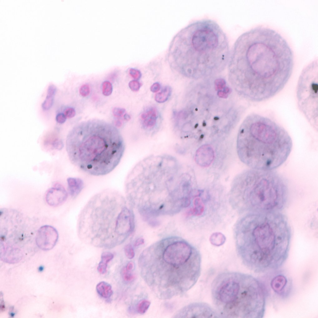 Makrophagen spielen eine zentrale Rolle bei der Abwehr von Krankheitserregern, sind aber auch an der Entstehung chronischer Entzündungen beteiligt. Zellen unter dem Mikroskop, violett und rosa gefärbt.