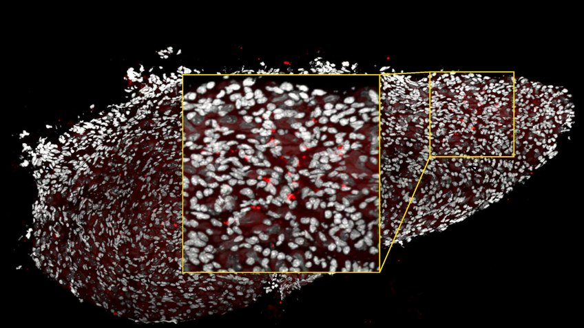Immunofluorescence image of a ganglion in a mouse with heart disease. The immune cells (macrophages) were marked red with an antibody, while the cell nuclei appear white. An area where many macrophages have accumulated is enlarged, indicating an immune response related to the heart disease. Immunofluorescence image of a ganglion in a mouse with heart disease