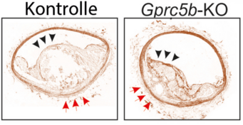 Weniger Atherosklerose, wenn GPRC5B fehlt. Die Abbildung zeigt einen mikroskopischen Schnitt durch Blutgefäße. Während bei der Kontrolle (links) im Innern des Blutgefäßes ein großer Plaque herangewachsen ist, fällt dieser bei Mäusen ohne aktives GPRC5B (rechts) wesentlich kleiner aus. Weniger Atherosklerose, wenn GPRC5B fehlt. Die Abbildung zeigt einen mikroskopischen Schnitt durch Blutgefäße. Während bei der Kontrolle (links) im Innern des Blutgefäßes ein großer Plaque herangewachsen ist, fällt dieser bei Mäusen ohne aktives GPRC5B (rechts) wesentlich kleiner aus.