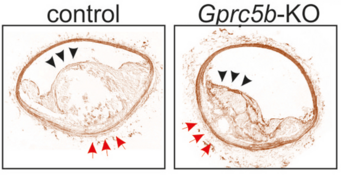 Less atherosclerosis if GPRC5B is absent. The figure shows a microscopic section through blood vessels. While a large plaque has grown inside the blood vessel in the control (left), this is much smaller in mice without active GPRC5B (right). Less atherosclerosis if GPRC5B is absent. The figure shows a microscopic section through blood vessels. While a large plaque has grown inside the blood vessel in the control (left), this is much smaller in mice without active GPRC5B (right).