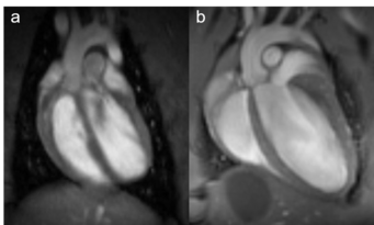 Fig. 1: Rat and mouse heart MRI. 4-chamber-views of a rat (a), upper panel and mouse heart (b), lower panel are displayed. Beside the lumen of the left and right chamber, the left and right atria, the myocardium and the up-going vessels are visible. For rat a 72 mm volume transmit-only together with 20 mm recieve-only planar surface coil, both room temperature, and for mouse the 72 mm volume transmit-only and the cryogenic 4 element 1H array receive-only coil were used. Intragate Flash (Fast Low Angle Shot) sequence for rat (repetition time: 6.2 ms; echo time: 1.3 ms; oversampling:150; flip angle: 10 deg; slice thickness: 1.0 mm; FOV: 45x45 mm and matrix: 128x128 .Intragate UTE (Ultra Short Echo Time) for mouse: repetition time: 8.0 ms; echo time: 0.36 ms; oversampling: 100; flip angle: 15 deg; slice thickness: 1.0 mm; FOV: 22x22 mm and matrix: 128x128. Fig. 1: Rat and mouse heart MRI. 4-chamber-views of a rat (a), upper panel and mouse heart (b), lower panel are displayed. Beside the lumen of the left and right chamber, the left and right atria, the myocardium and the up-going vessels are visible. For rat a 72 mm volume transmit-only together with 20 mm recieve-only planar surface coil, both room temperature, and for mouse the 72 mm volume transmit-only and the cryogenic 4 element 1H array receive-only coil were used. Intragate Flash (Fast Low Angle Shot) sequence for rat (repetition time: 6.2 ms; echo time: 1.3 ms; oversampling:150; flip angle: 10 deg; slice thickness: 1.0 mm; FOV: 45x45 mm and matrix: 128x128 .Intragate UTE (Ultra Short Echo Time) for mouse: repetition time: 8.0 ms; echo time: 0.36 ms; oversampling: 100; flip angle: 15 deg; slice thickness: 1.0 mm; FOV: 22x22 mm and matrix: 128x128.