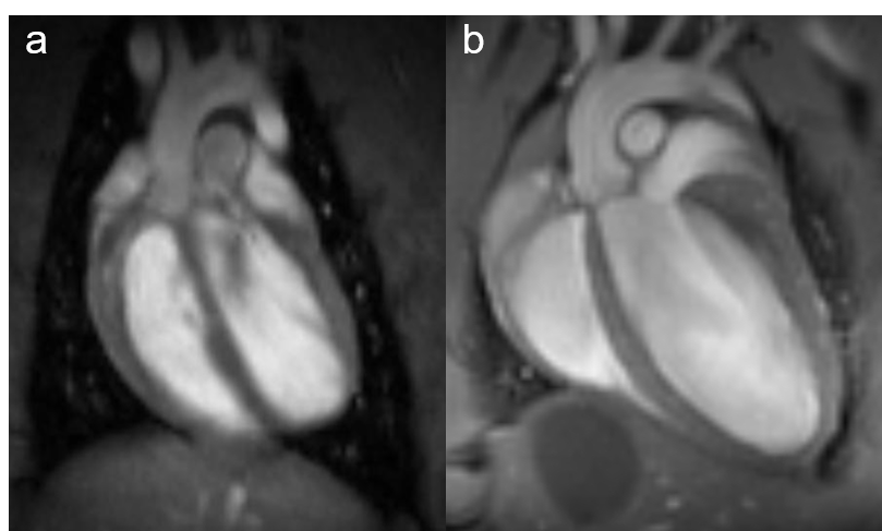 Fig. 1: Rat and mouse heart MRI. 4-chamber-views of a rat (a), upper panel and mouse heart (b), lower panel are displayed. Beside the lumen of the left and right chamber, the left and right atria, the myocardium and the up-going vessels are visible. For rat a 72 mm volume transmit-only together with 20 mm recieve-only planar surface coil, both room temperature, and for mouse the 72 mm volume transmit-only and the cryogenic 4 element 1H array receive-only coil were used. Intragate Flash (Fast Low Angle Shot) sequence for rat (repetition time: 6.2 ms; echo time: 1.3 ms; oversampling:150; flip angle: 10 deg; slice thickness: 1.0 mm; FOV: 45x45 mm and  matrix: 128x128 .Intragate UTE (Ultra Short Echo Time) for mouse: repetition time: 8.0 ms; echo time: 0.36 ms; oversampling: 100; flip angle: 15 deg; slice thickness: 1.0 mm; FOV: 22x22 mm and  matrix: 128x128.