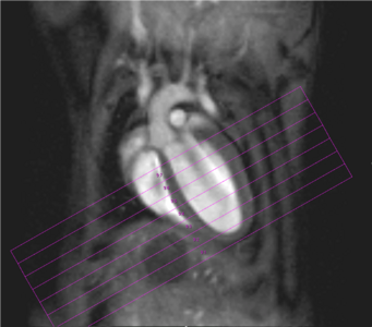 Fig. 2: Mouse heart MRI. In the upper panel the endsystolic (a) and enddiastolic (b) phase of a mouse heart in the 4-chamber-view is displayed. In red: position of the 7 slices, orthogonal to the septum (1.0 mm thick, no gap). In the lower panel in (c) the endsystolic and in (d) the enddiastolic phase of an axial midventricular slice is shown. Note the papillary muscle. Fig. 2: Mouse heart MRI. In the upper panel the endsystolic (a) and enddiastolic (b) phase of a mouse heart in the 4-chamber-view is displayed. In red: position of the 7 slices, orthogonal to the septum (1.0 mm thick, no gap). In the lower panel in (c) the endsystolic and in (d) the enddiastolic phase of an axial midventricular slice is shown. Note the papillary muscle.