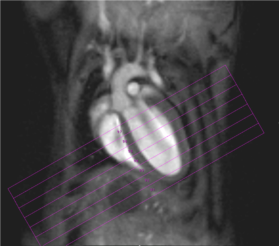 Fig. 2: Mouse heart MRI. In the upper panel the endsystolic (a) and enddiastolic (b) phase of a mouse heart in the 4-chamber-view is displayed. In red: position of the 7 slices, orthogonal to the septum (1.0 mm thick, no gap). In the lower panel in (c) the endsystolic and in (d) the enddiastolic phase of an axial midventricular slice is shown. Note the papillary muscle.